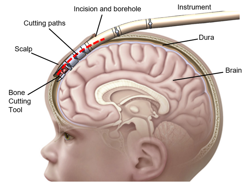 Ossentra articulating instrument following the curved endoscopic path beneath the scalp